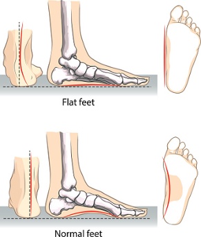 What Causes Flat Feet Pain | HyProCure 