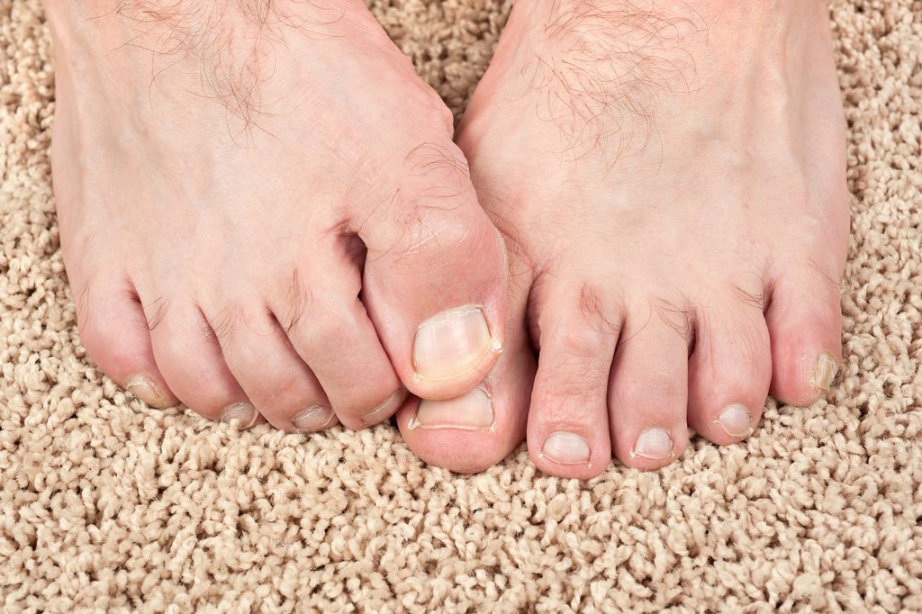 dr-graham-answers-the-question-how-to-get-rid-of-yellow-toenails