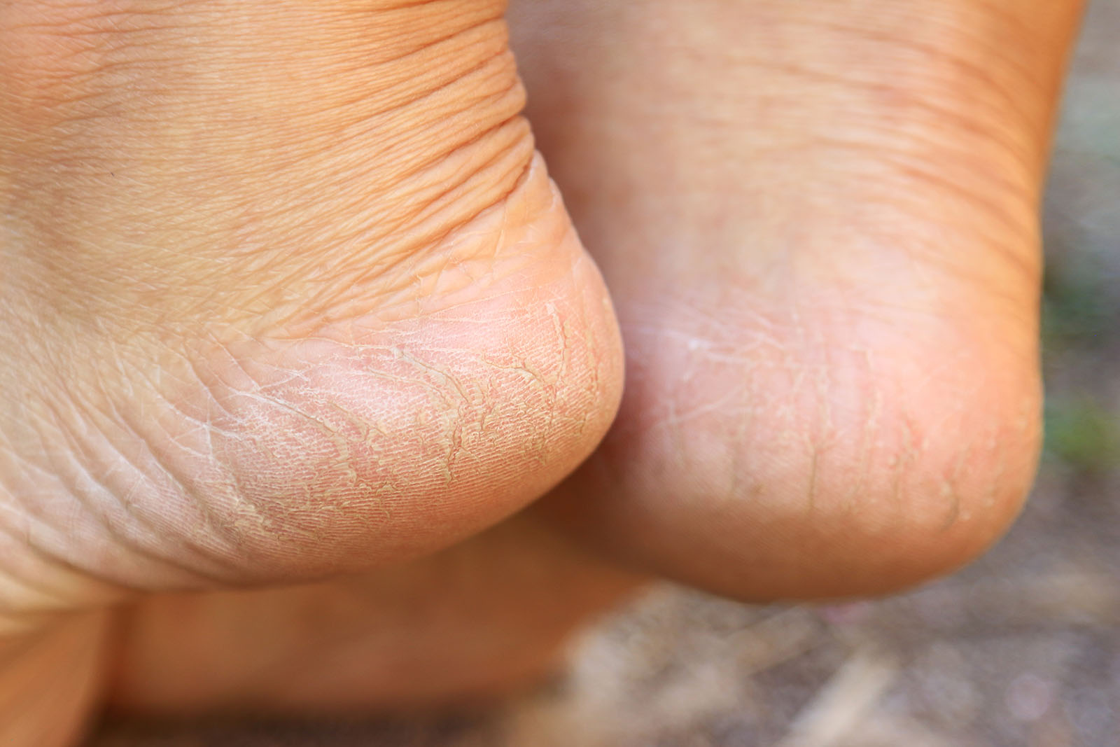 How to treat cracked heels with diabetes