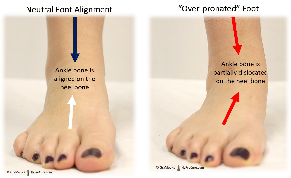 Misaligned over pronated Feet HyProCure The Proven Solution To 