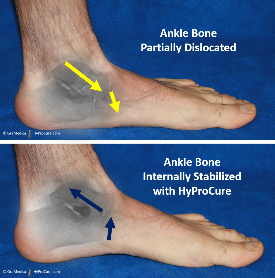 pain in arch of foot