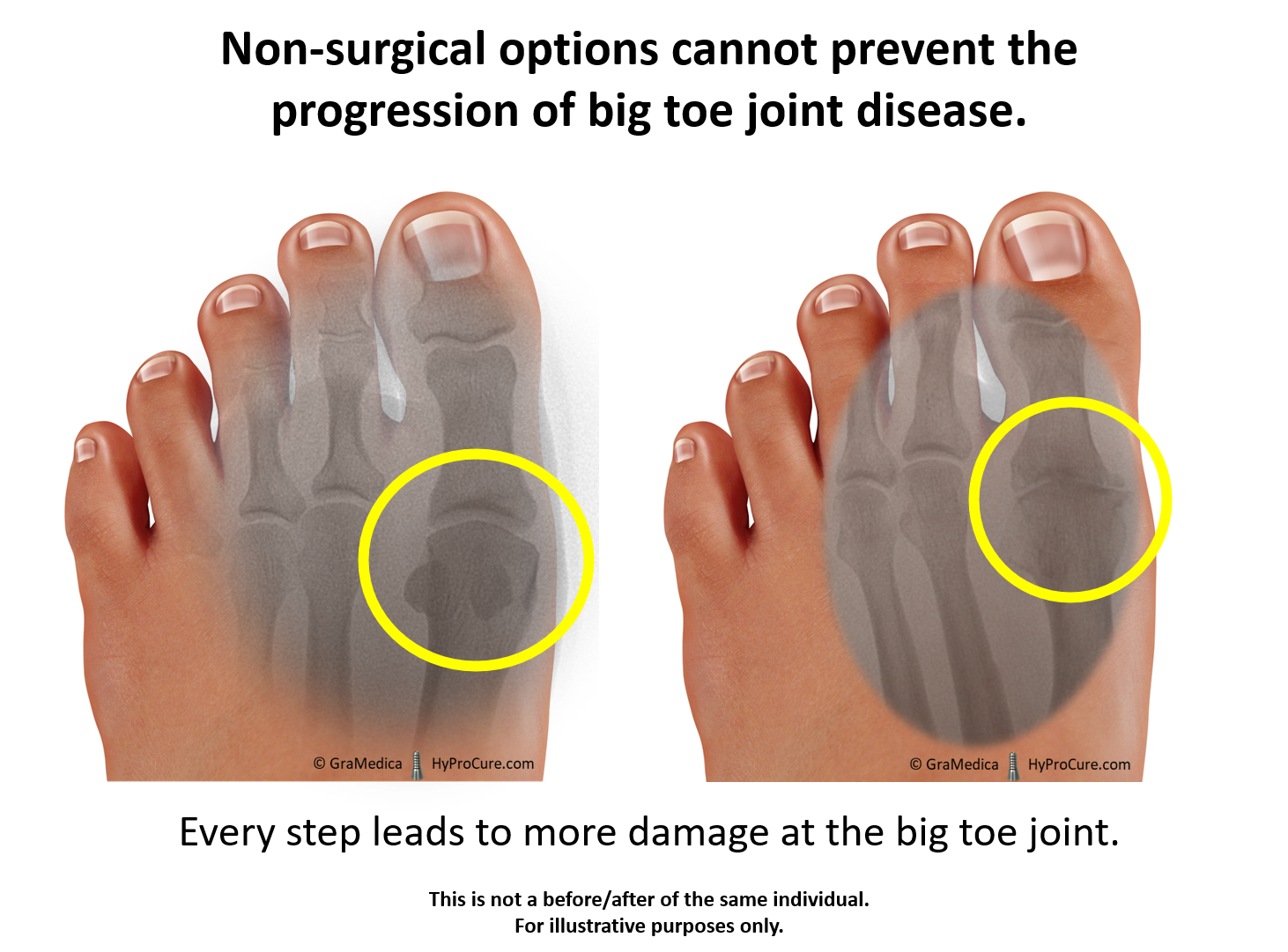 Big Toe Joint Pain Limitedpainful Motion Hyprocure The Proven