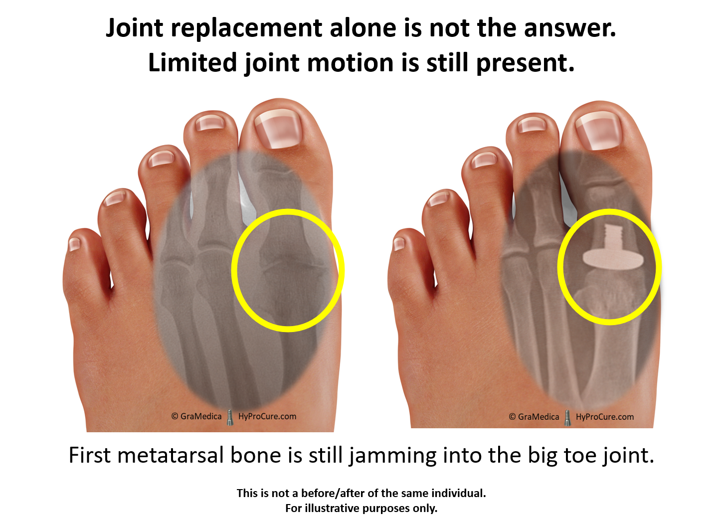 How to avoid toe jam, that icky buildup between your toes