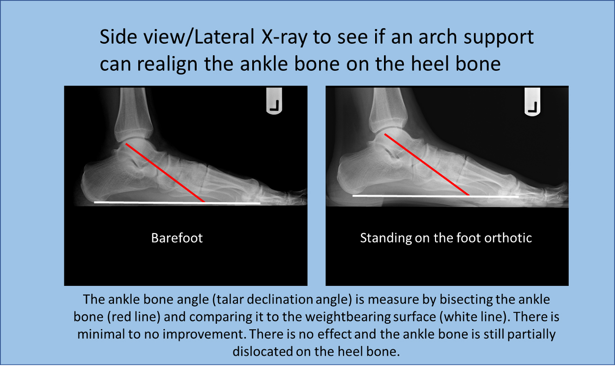EMRad: Radiologic Approach to the Traumatic Ankle