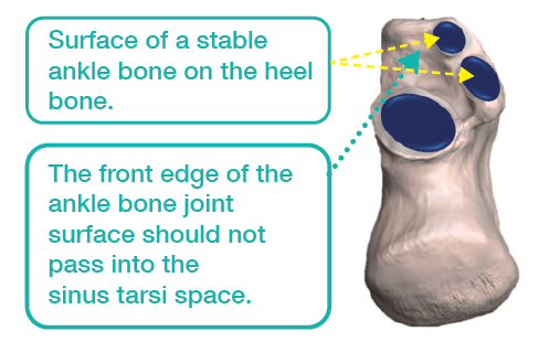 Normal alignment of the ankle bone on the heel bone