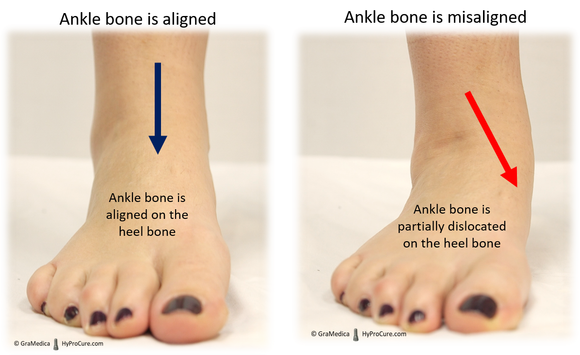 What do misaligned feet look like?